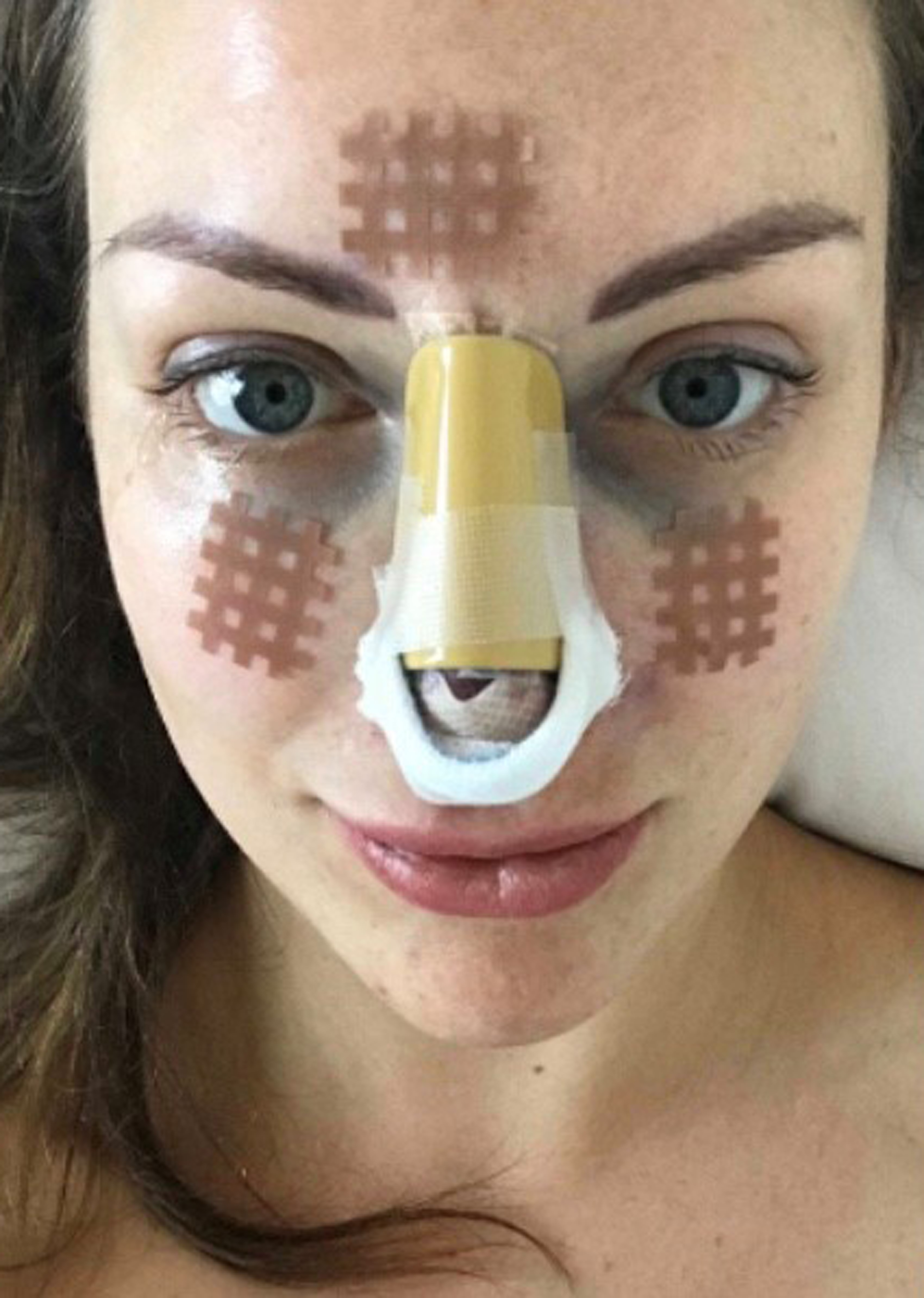 The mum forked out £4,000 for her nose job in 2017