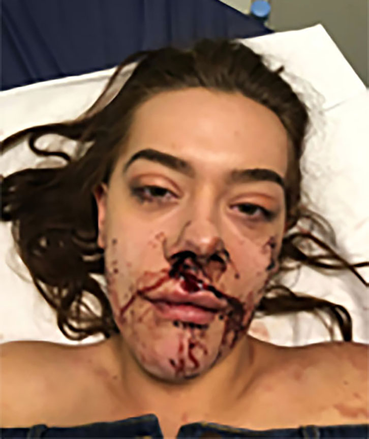  She was struck with a glass bottle by a reveller who was being kicked out of the club