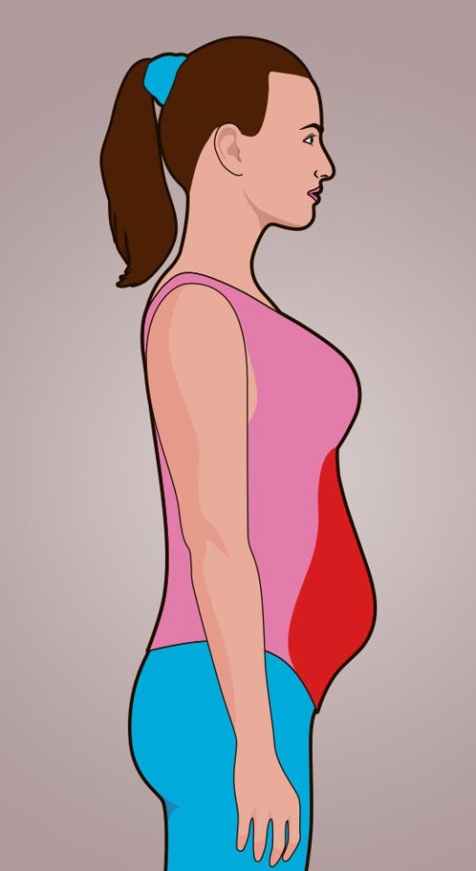  The graphic above shows what a bloated belly looks like. With the small pouch seen at the bottom of the stomach