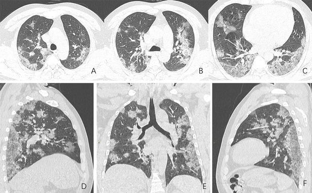  These X-rays, of a 44-year-old man who died from coronavirus, show damage to his lungs