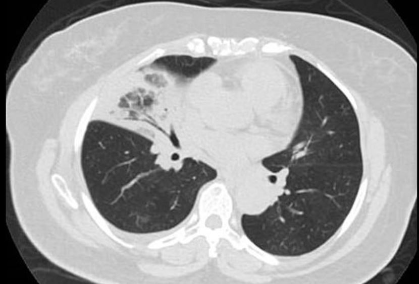  Doctors from The Mount Sinai Health System in New York say CT scans may be faster than nasal and throat swabs at diagnosing coronavirus