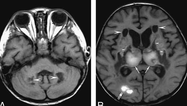  The dark spots on these brain scans, of a 58-year-old coronavirus patient, indicate cell death in patients with encephalitis