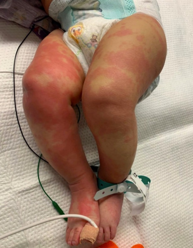  The six-month-old baby girl's legs were covered in a red, bumpy rash - believed to be Kawasaki disease