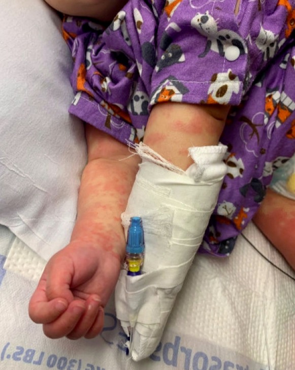  The youngster's hands were swollen and covered in a red, blotchy rash