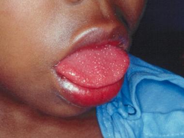  Doctors say the syndrome is similar to toxic shock syndrome and Kawasaki disease, which can cause redness of the tongue, stock image