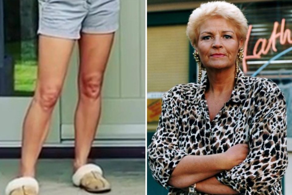  Or does her knee resemble Pat Butcher?