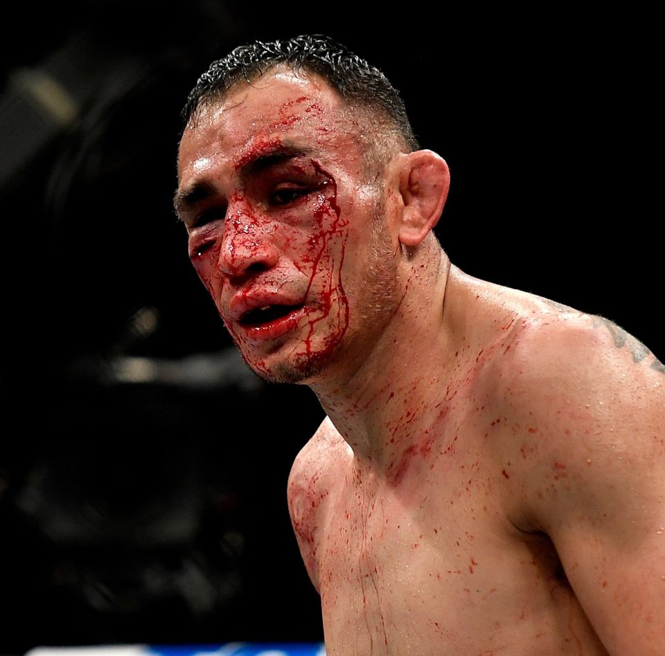  Tony Ferguson broke his eye socket in a brutal beating by Justin Gaethje at the weekend