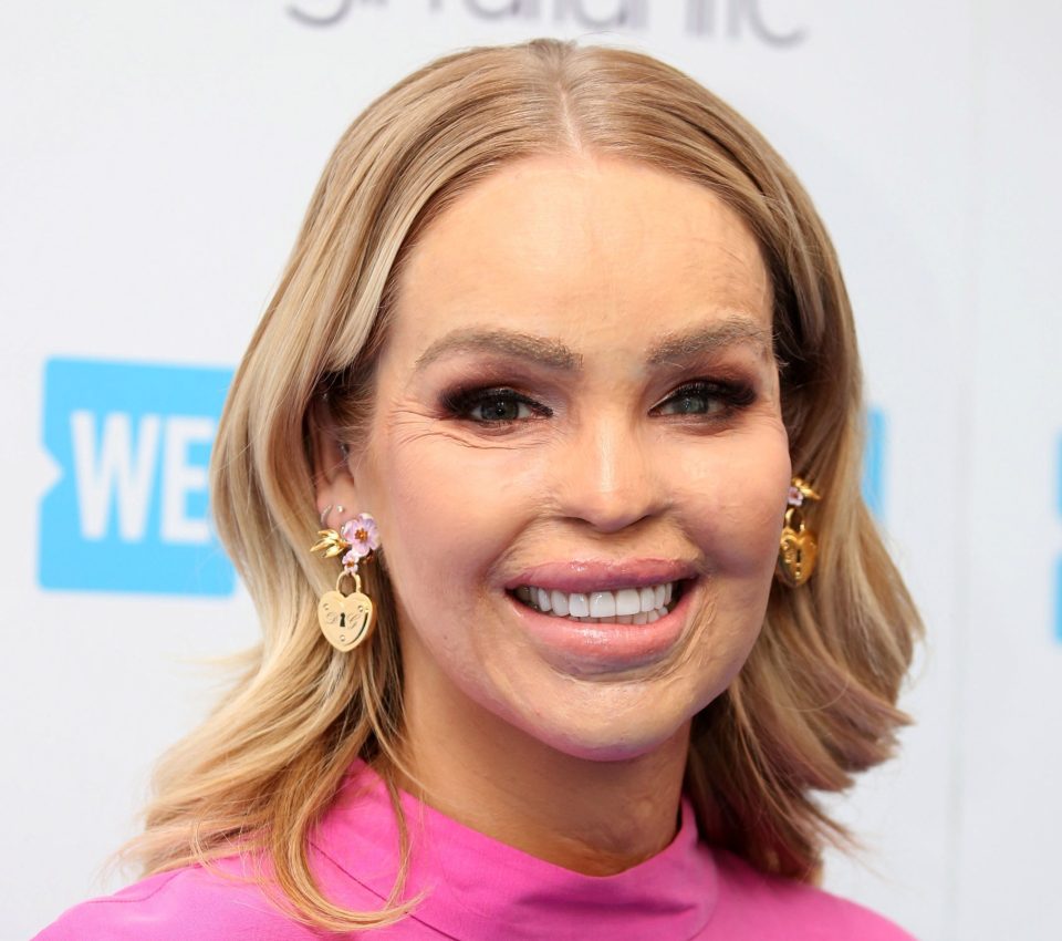  Model Katie Piper was disfigured after thug Stefan Sylvestre threw sulphuric acid at her in 2008