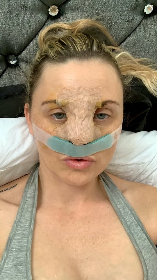 Carla previously had a nose job on the NHS