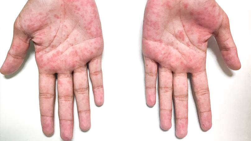  The syndrome presents in a similar way to Kawasaki disease which causes redness of the hands