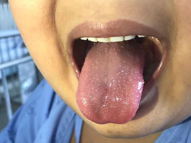  The condition causes inflammation and redness of the tongue, file image of a child with Kawasaki disease