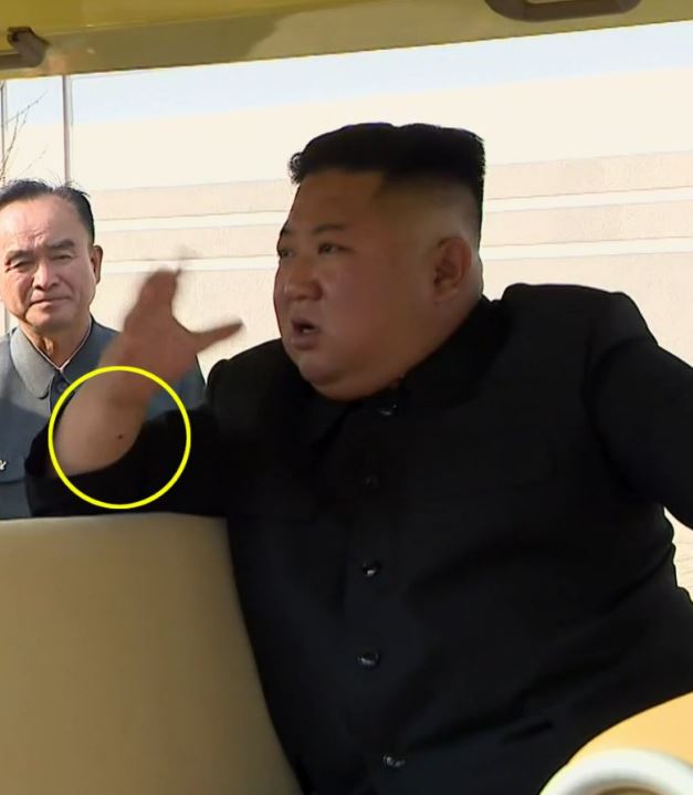  Kim Jong-un is pictured with what appears to be a needle mark yesterday after vanishing for 20 days