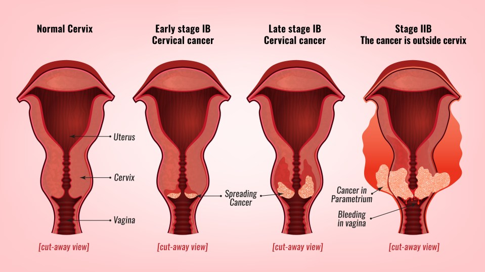 Cervical cancer is almost always treatable if it's caught early on