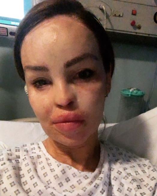 The model had a total of 40 operations to treat her severe burns