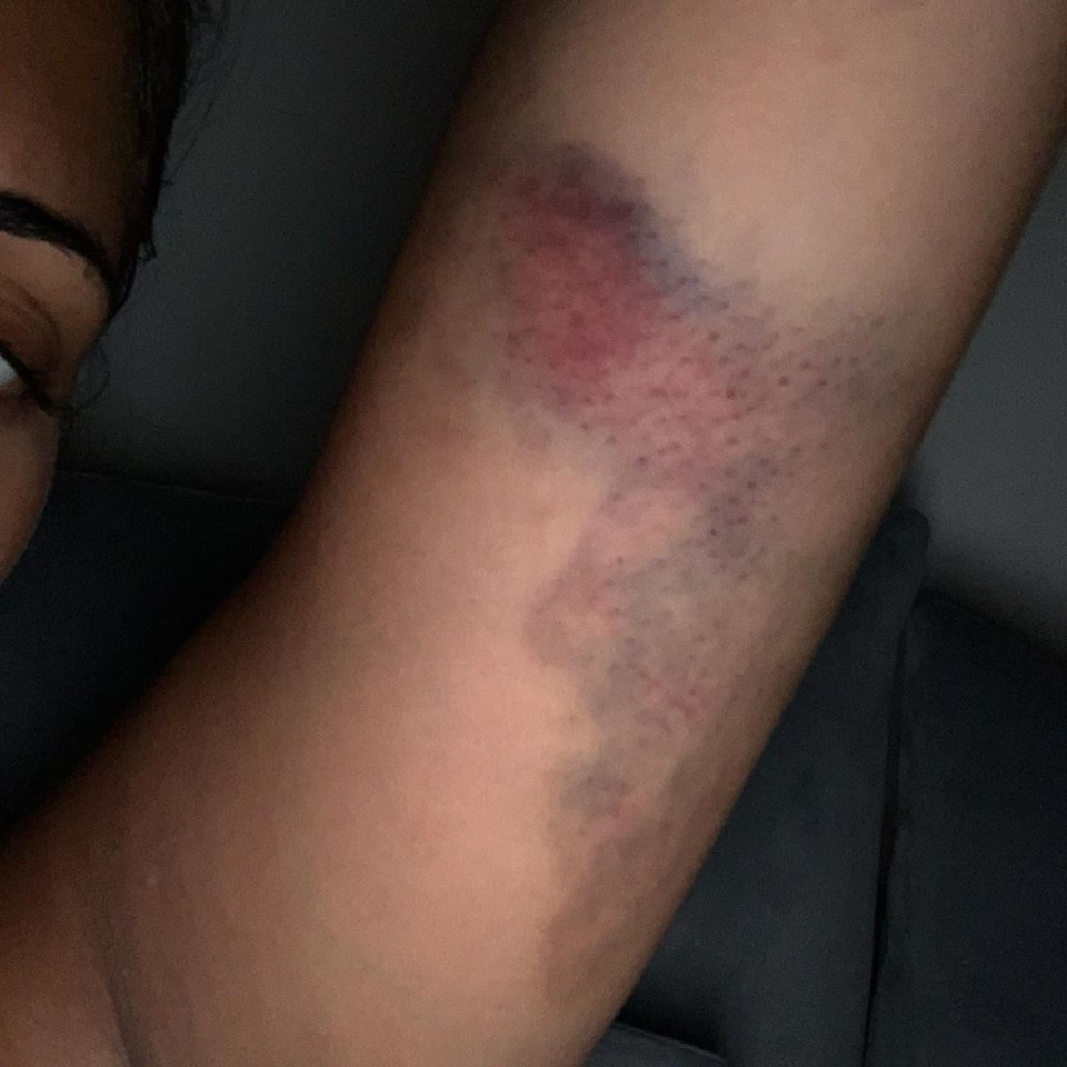 Malin says the emotional and physical abuse left her feeling ‘worthless’ and she shared a photo of her badly bruised arm on Instagram