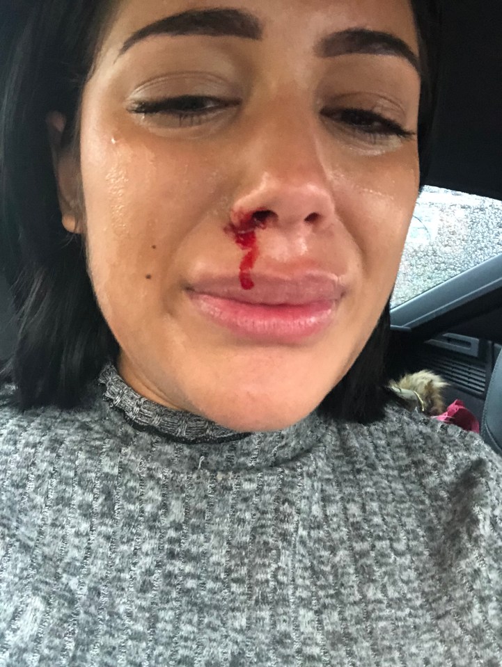 Malin shared a distressing image of her bloodied nose