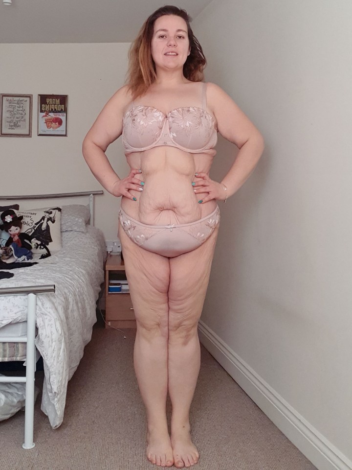 Hannah has been left with agonising excess skin – which weighs more than a stone