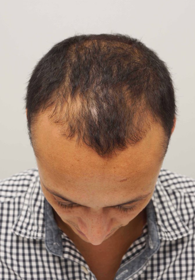 The process involves taking hairs from the back of the head and inserting them into the thinning area at the front