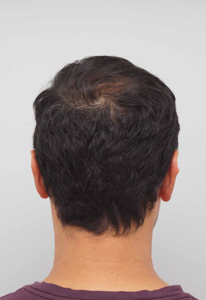 Chris' procedure involved 2,900 individual grafts of 6,400 hairs across the front of his head