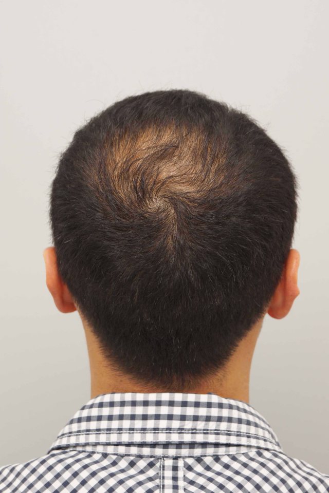 Chris had two Follicular Unit Extraction hair transplants