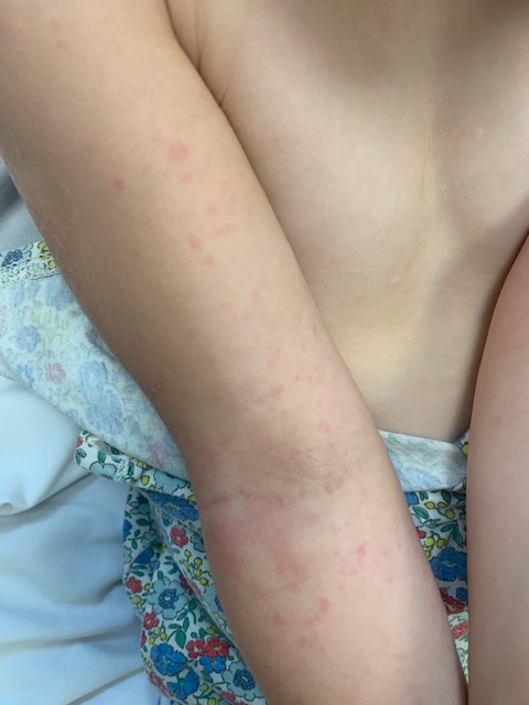 The tot has a raised rash up and down her arms