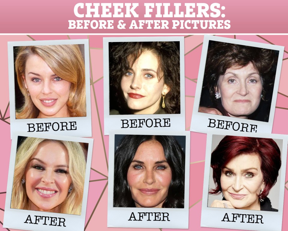 Kylie Minogue, Courtney Cox and Sharon Osbourne have all admitted to using fillers