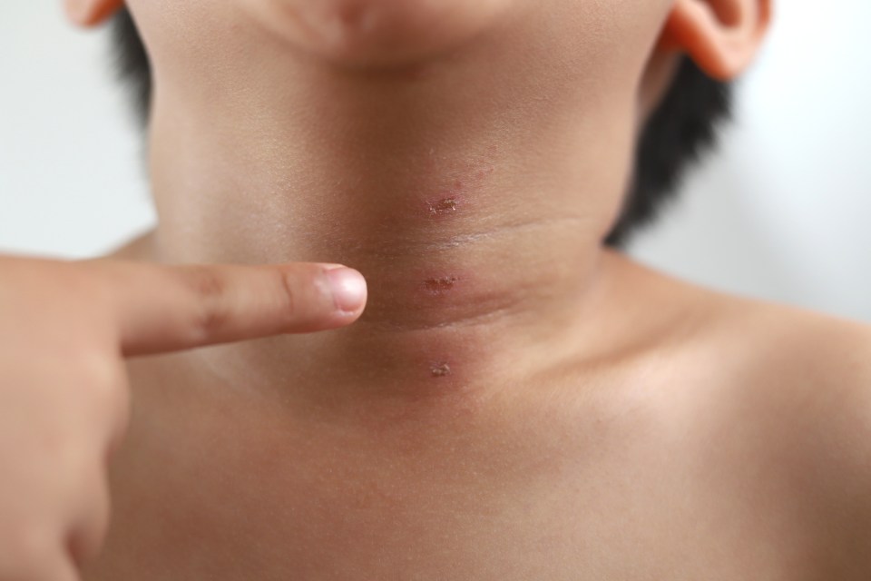 Close-up of painful wounds on kid's neck after being bitten by ants