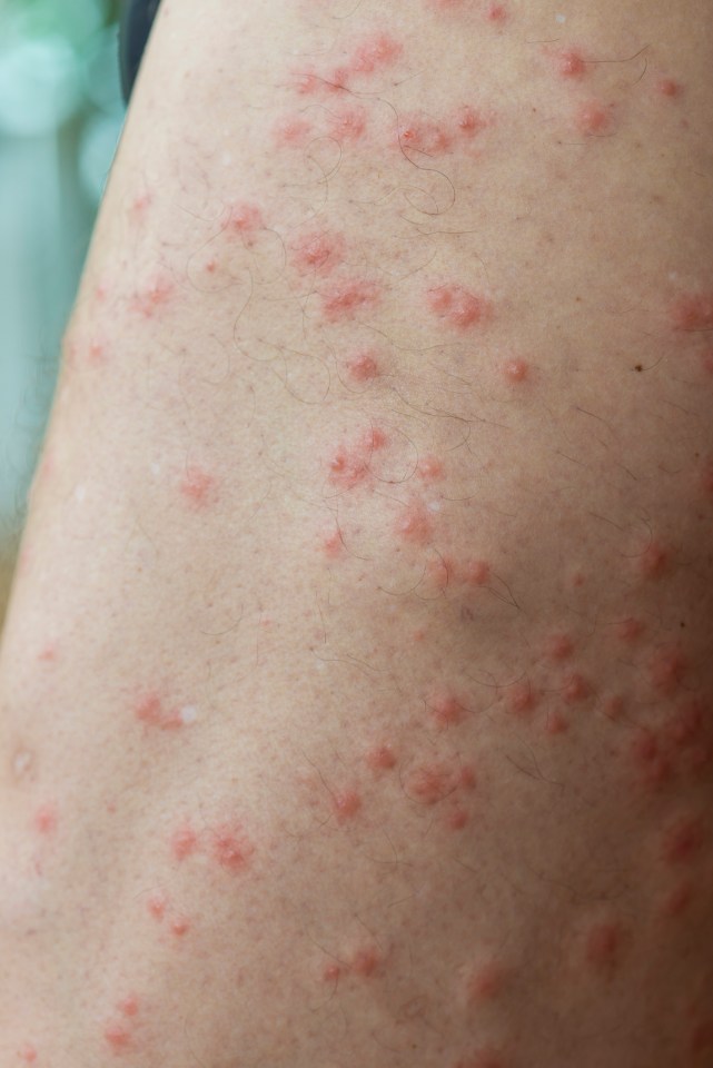 Sand fly bites can be uncomfortable and you can use antihistamines to help