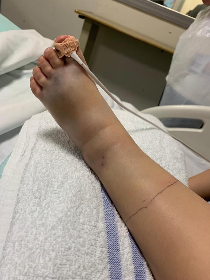 The boy's swollen foot after he was attacked by a snake