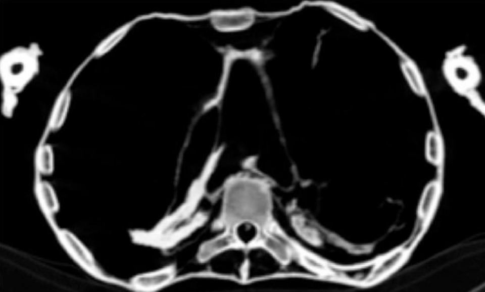 The CT scan showed that she suffered from atherosclerosis of the right and left coronary arteries, neck arteries and abdominal aorta