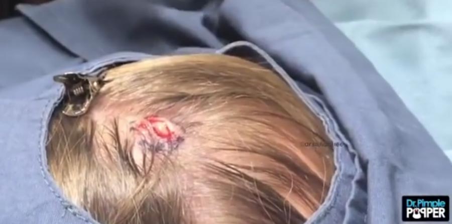 Once the puss was removed the patient was still left with something inside her scalp 