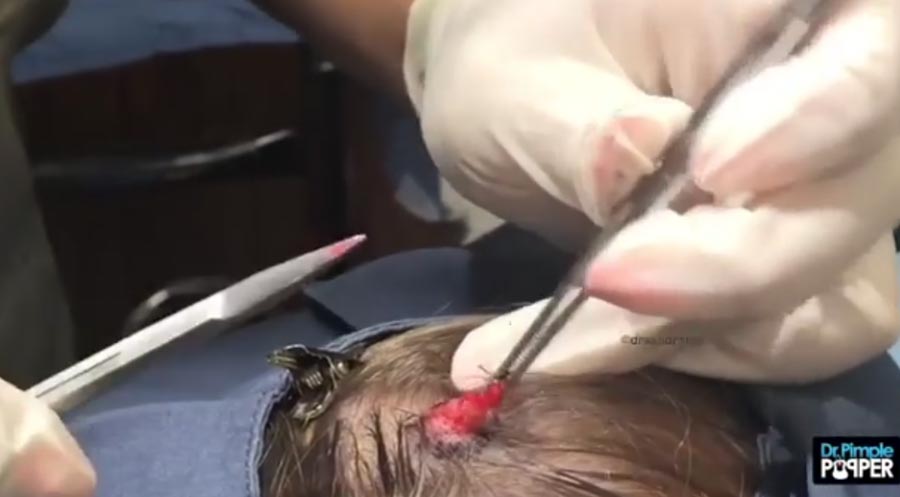 The sack of the scalp then has to be removed so that the cyst never grows back 