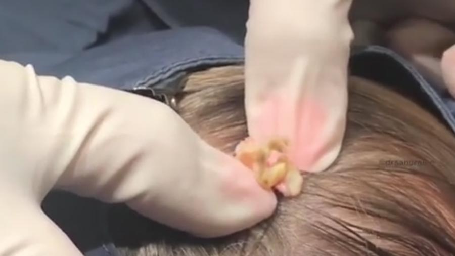 The puss oozed out of the patient's scalp, before Dr Lee removed it 