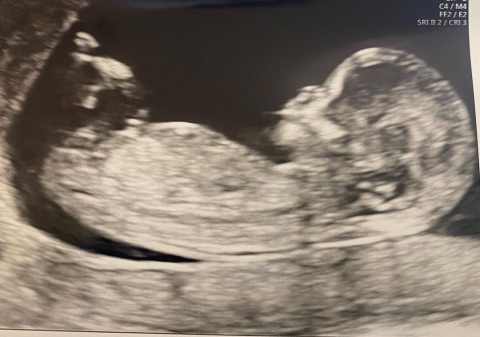 Dani posted a close-up of the baby scan