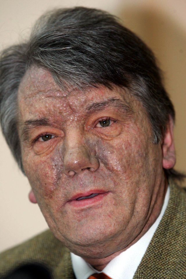 Viktor Yushchenko survived his soup being poisoned, but his face was left disfigured