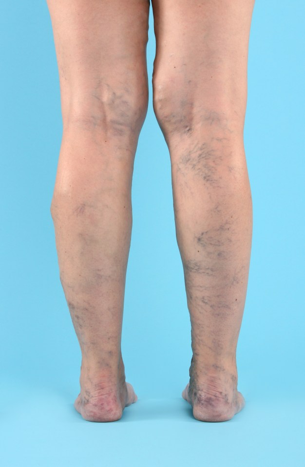 Varicose veins are usually found on the legs 