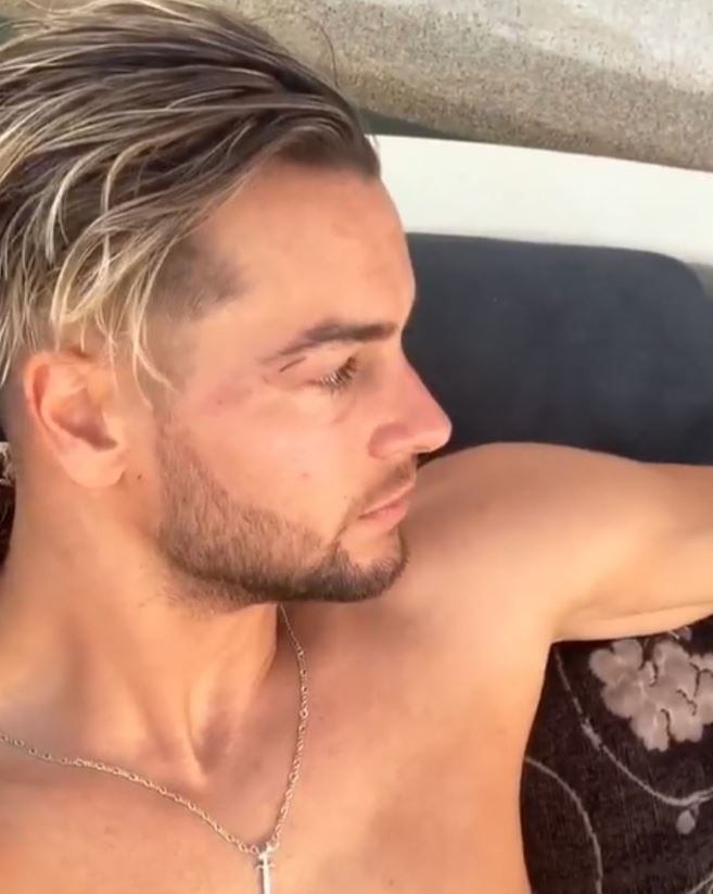 Love Island's Chris Hughes suffered a black eye while in Mykonos