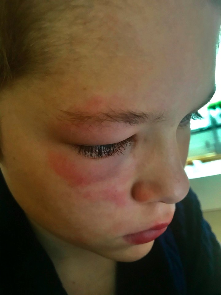 William Thomas was hurt after he brushed past a hogweed