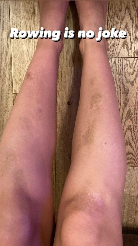 Lucy Fallon revealed painful looking bruises on her legs from filming new show Don’t Rock The Boat.