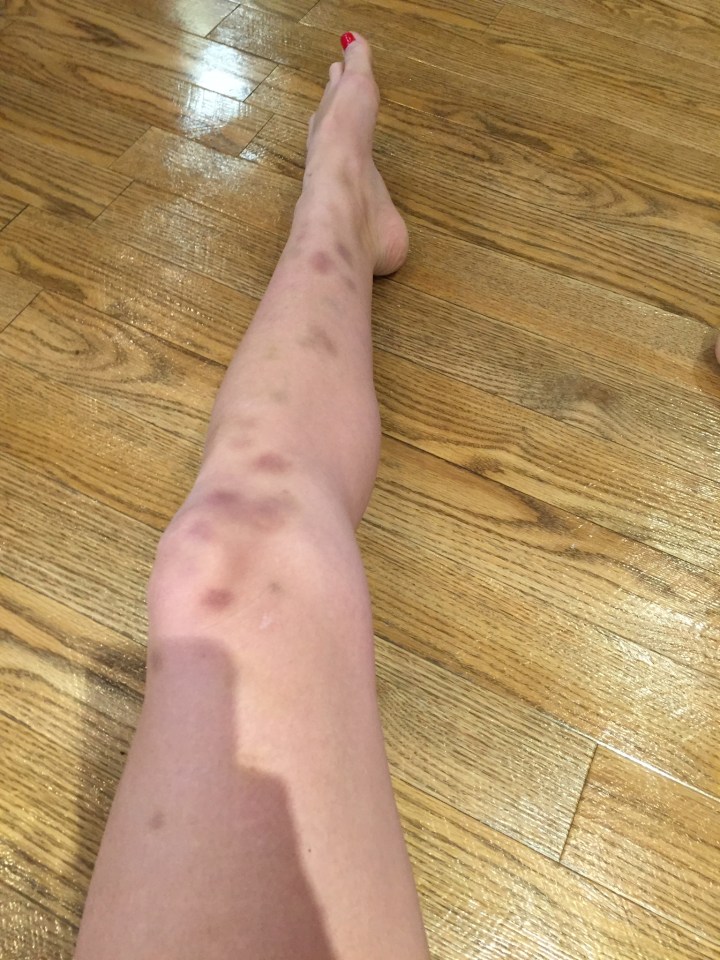 Bruises led Laura to discover she had a dangerous autoimmune disease