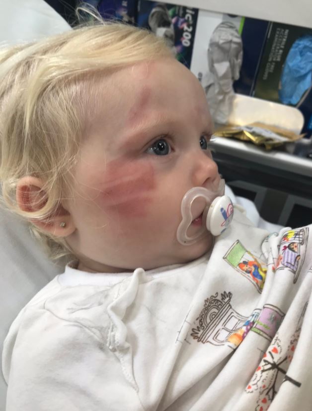 Freya Clancy, who is just 16-months-old, was left with a huge scratch on her face after the incident in Victoria Park yesterday 