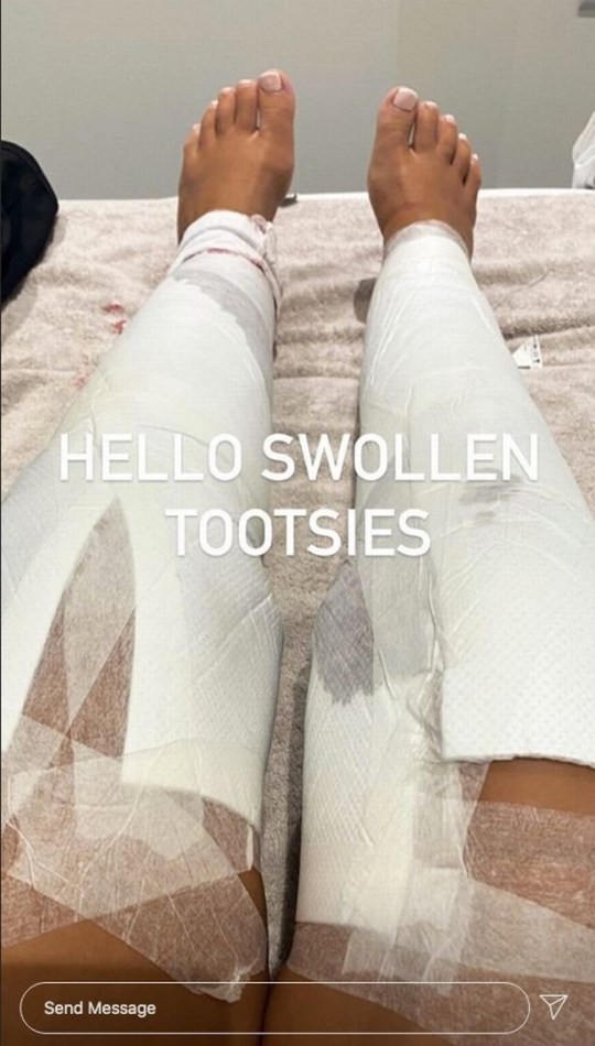 Posting to Instagram, Shaughna showed how her legs and ankles had been bandaged 