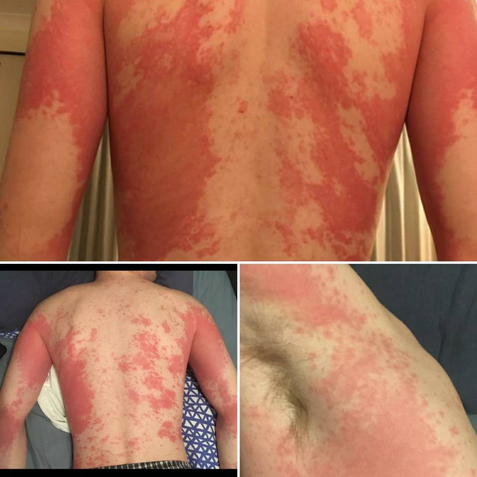 Experts say that a skin rash should be considered as an official coronavirus symptom