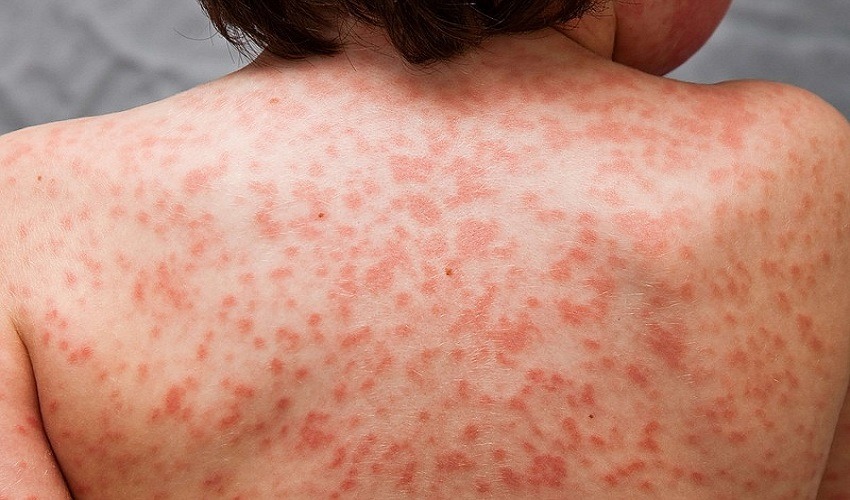 One of the symptoms of the illness is a rash and inflammation