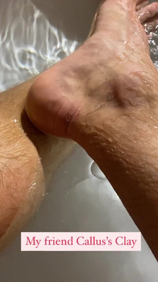 The reality star showed off some painful looking cuts on his feet