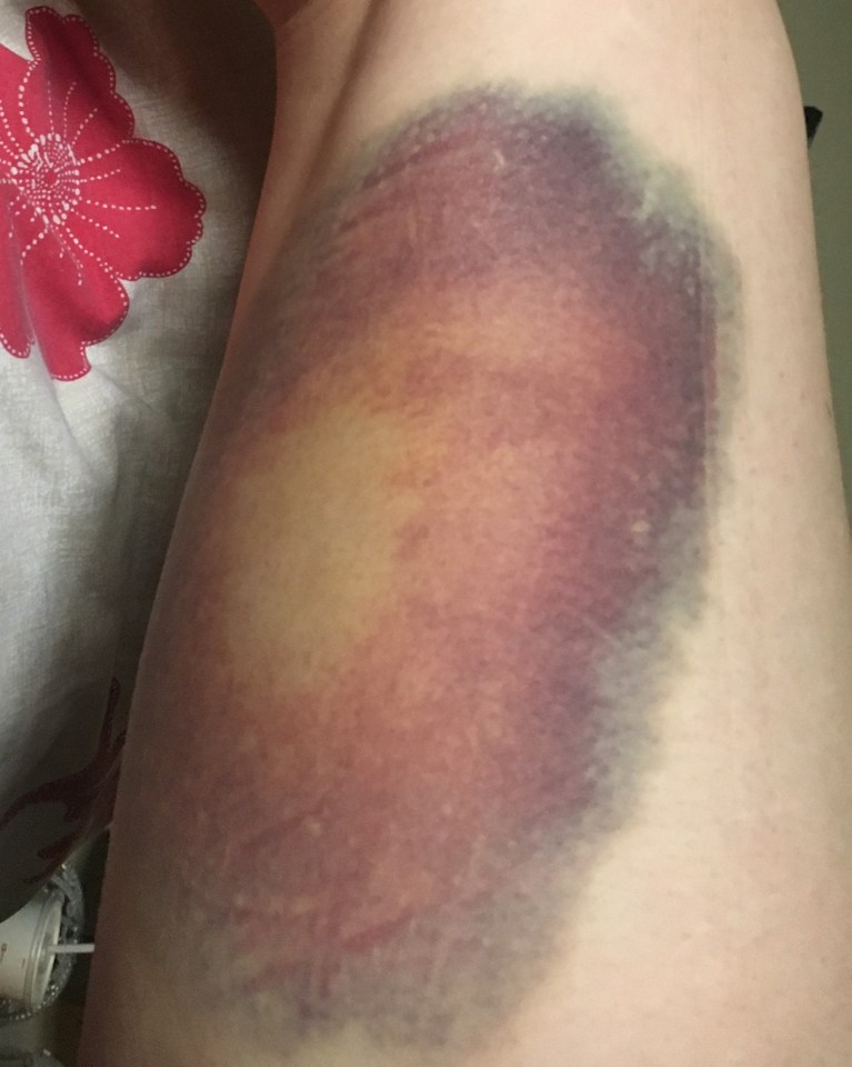 A closer look at the Boyle-like bruise