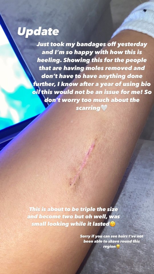 She shared a picture of her scar - but warned it's going to 'triple in size'