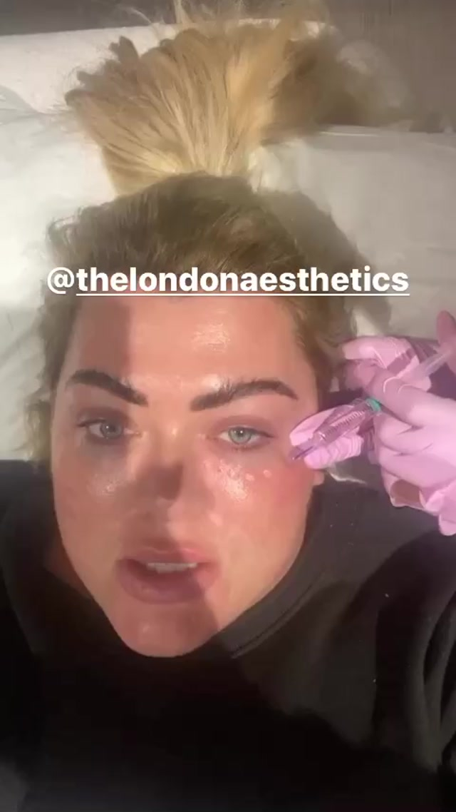 Gemma had fat dissolving injections