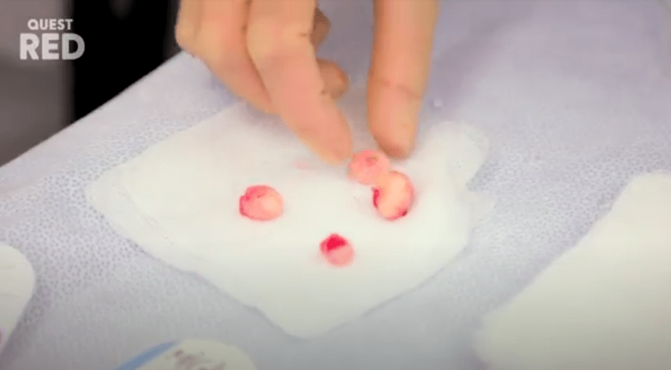 She placed the four 'marble-shaped' growths on her medical tray