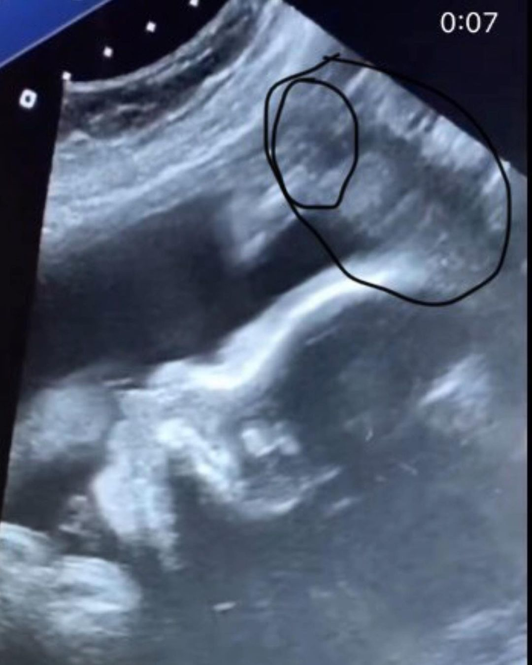 She previously said she could see her late dad's face in a baby scan